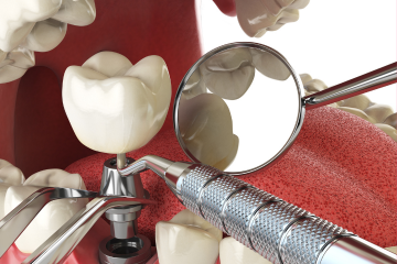 Implantologia e trasmissione codice UDI